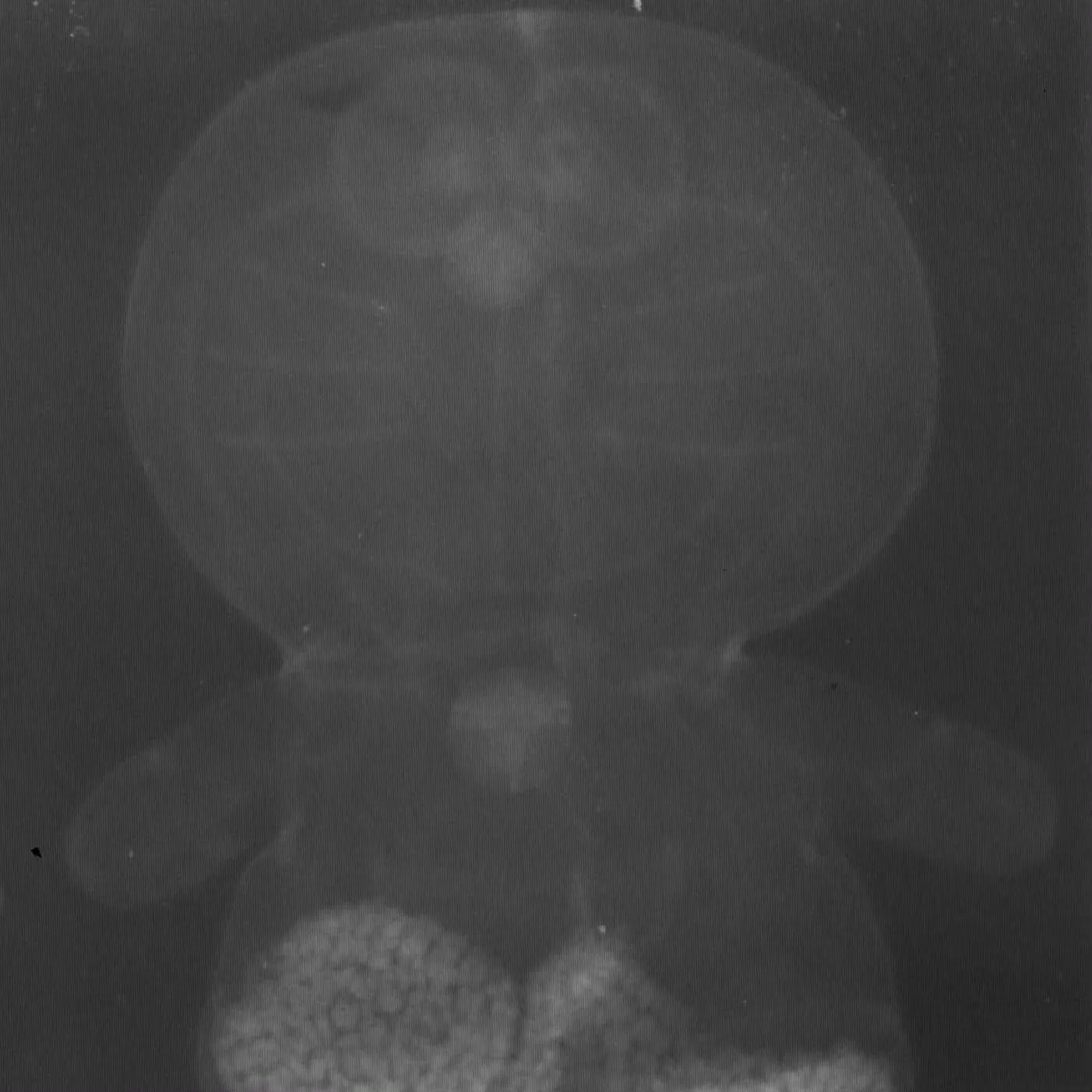 【異物】ドラえもんのレントゲン【食べた場合】