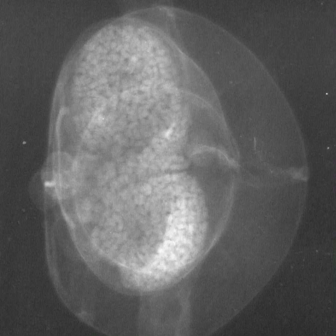 【異物】ドラえもんのレントゲン【食べた場合】